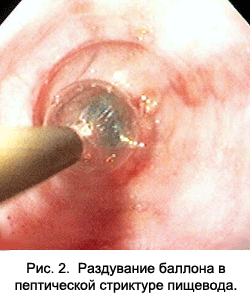 раздувание баллона в стриктуре пищевода