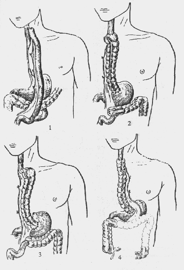 несколько вариантов пластики пищевода