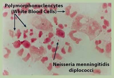 лейкоциты сражаются с менингококкоками