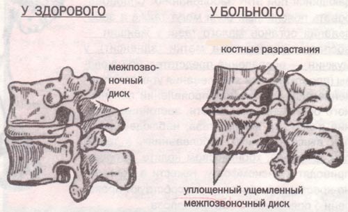 позвонки в норме и при остеохондрозе