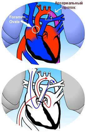овальное отверстие и артериальный проток