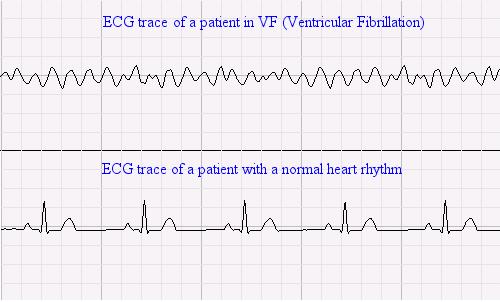 ЭКГ в норме и при фибрилляции желудочков