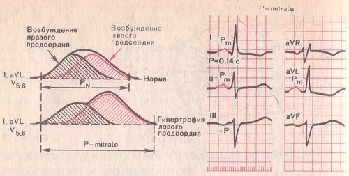 формирование зубца P (P-mitrale) при гипертрофии левого предсердия.