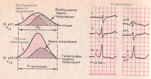 формирование зубца P (P-pulmonale) при гипертрофии правого предсердия