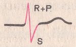 ритм из AV-соединения, наложение зубца P на комплекс QRS