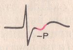 ритм из AV-соединения, зубец P находится после комплекса QRS