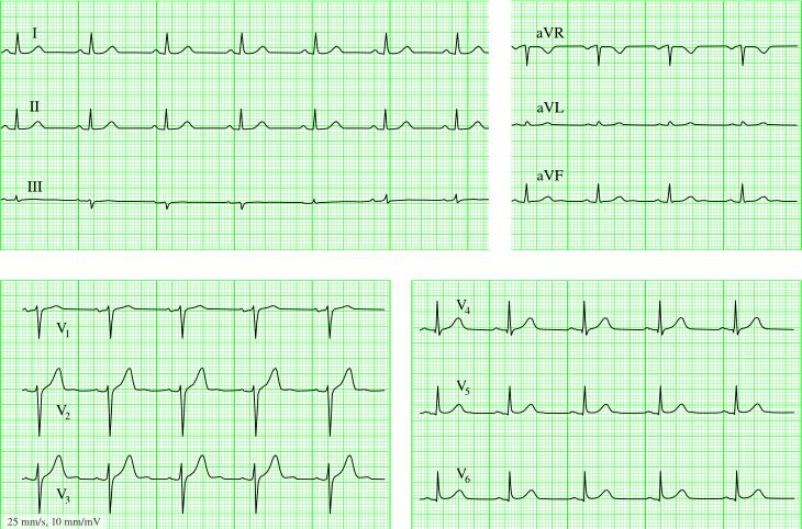 нормальная электрокардиограмма