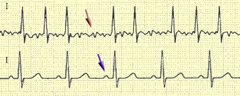 сравнение синусового ритма и пароксизмальной мерцательной аритмии на ЭКГ