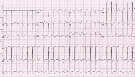пример пароксизмальной наджелудочковой тахикардии на ЭКГ
