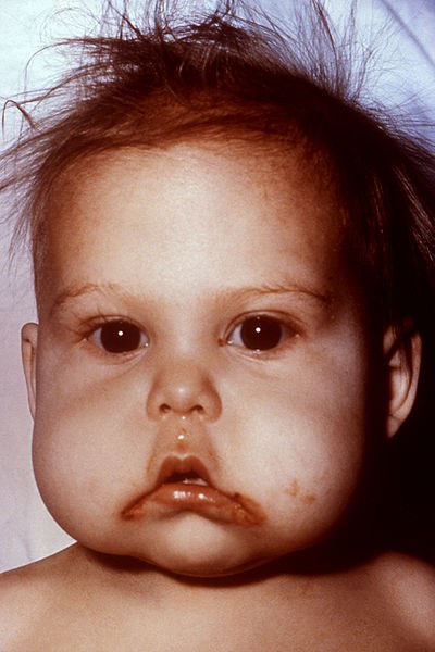 у ребёнка, страдающего квашиоркором, наблюдается истончение волос, отёчность лица, недостаток веса и отставание в росте