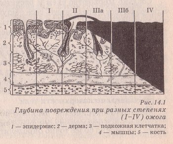 глубина повреждения при разных степенях ожога