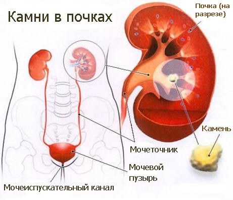 мочевыделительная система и камни в почках