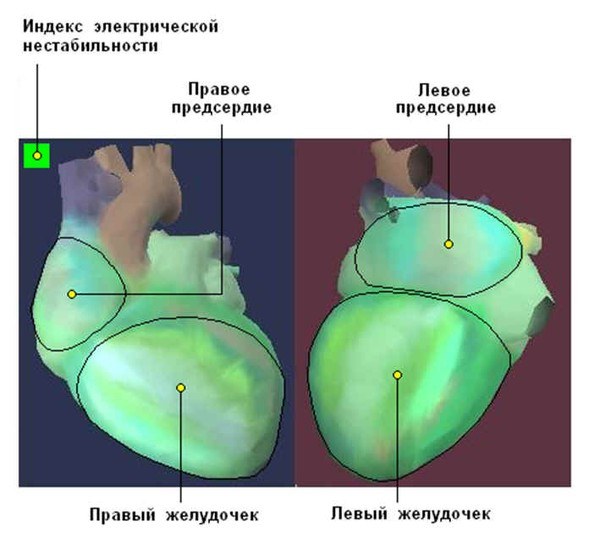 индекс электрической нестабильности сердца