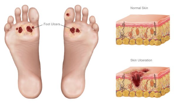диабетическая стопа: язвы