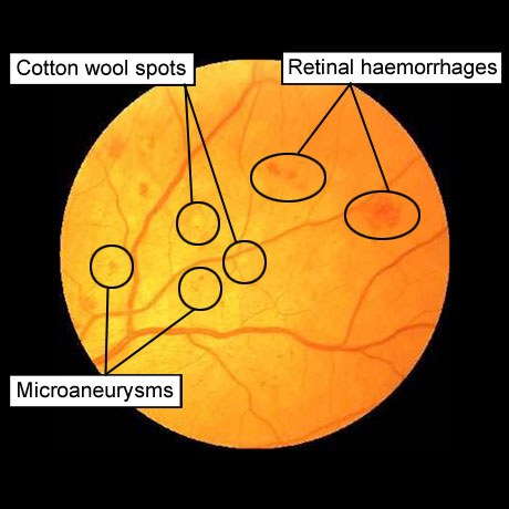 диабетическая ретинопатия: микроаневризмы, ватные пятна, геморрагии