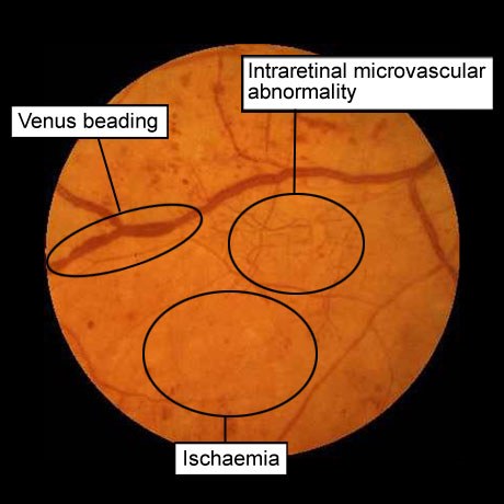 диабетическая ретинопатия: венозные аномалии, микрососудистая патология внутри сетчатки, ишемия