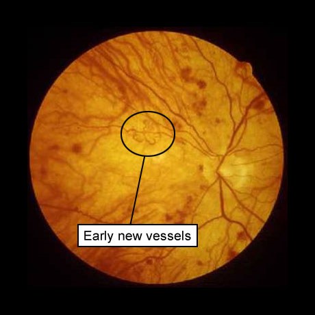 диабетическая ретинопатия: новые, недавно образованные кровеносные сосуды