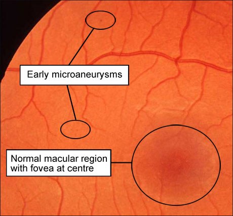 ранние микроаневризмы на глазном дне