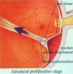 рубцовые тяжи в стекловидное тело при сморщивании приводят к отслойке сетчатки