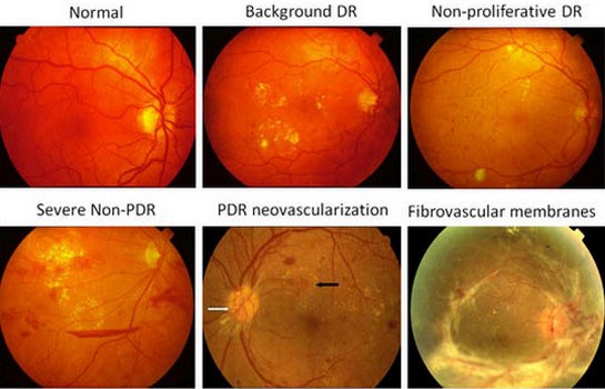стадии диабетической ретинопатии