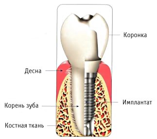 строение имплантата