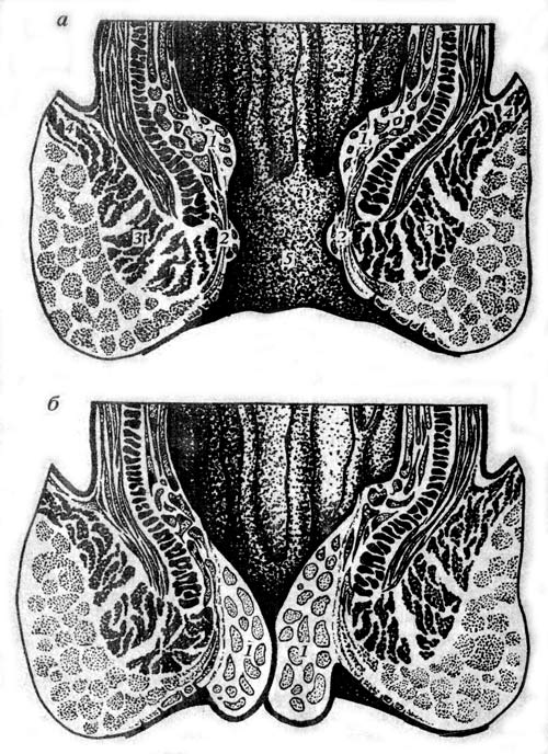 образование геморроидальных узлов