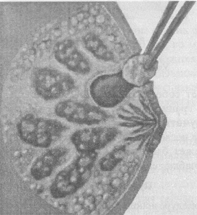 секторальная резекция молочной железы