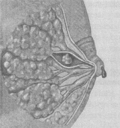 папиллома молочной железы