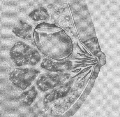 киста молочной железы