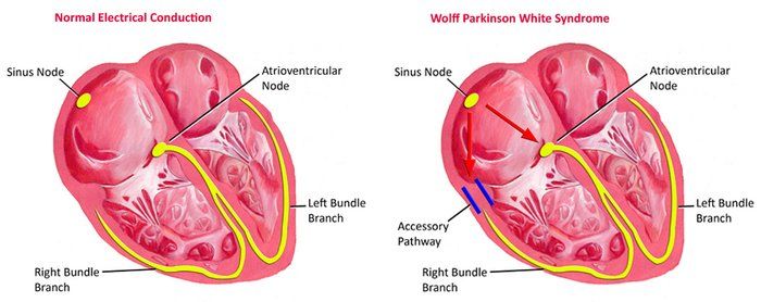 синдром Вольфа-Паркинсона-Уайта