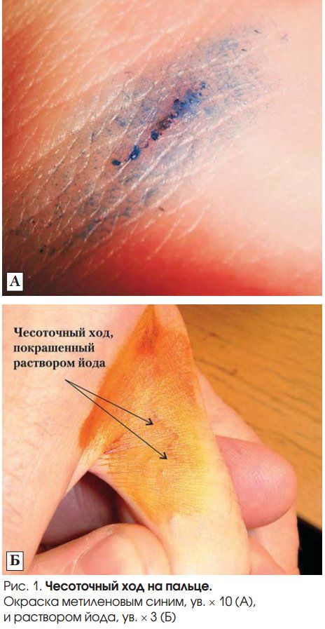 чесоточный ход на пальце, окраска метиленовым синим и раствором йода