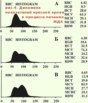 динамика RDW при лечении железодефицитной анемии