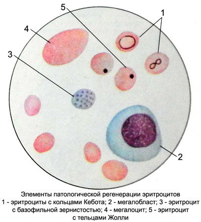 периферическая кровь при B12-фолиеводефицитной анемии