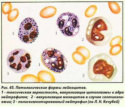 токсическая зернистость нейтрофилов