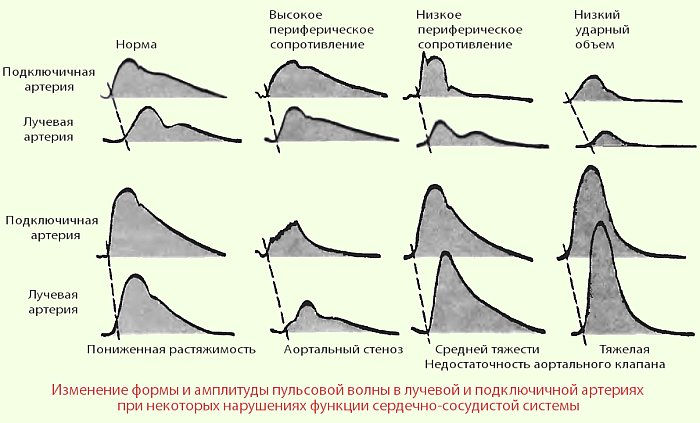 изменения пульсовой волны при некоторых патологиях