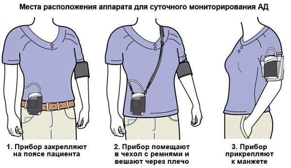 суточное мониторирование артериального давления