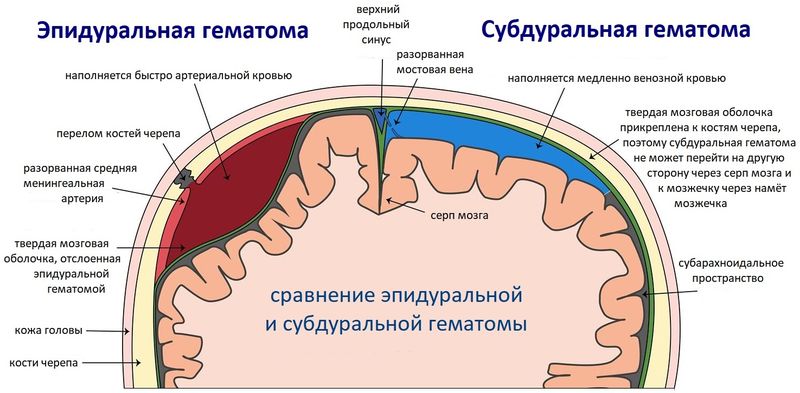 сравнение субдуральной и эпидуральной гематомы