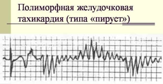 полиморфная желудочковая тахикардия типа пируэт