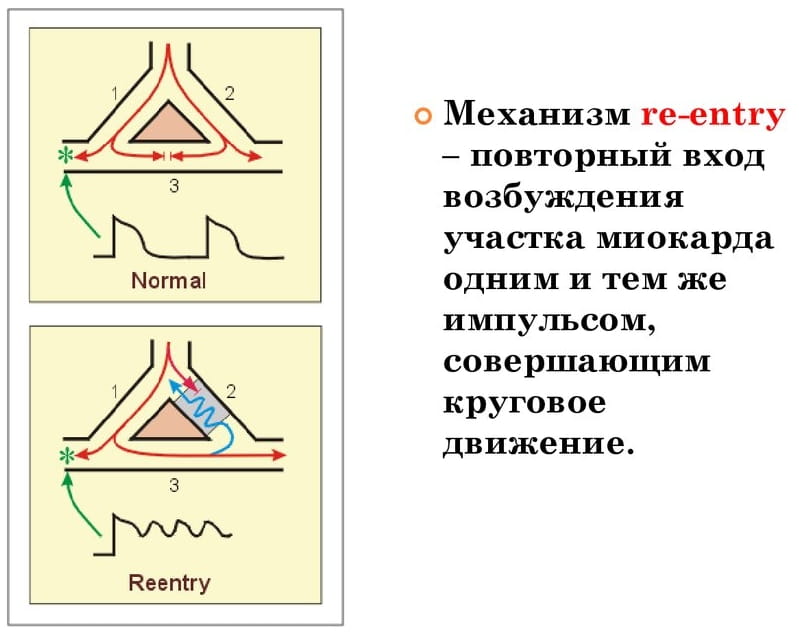 механизм обратного входа возбуждения (re-entry)