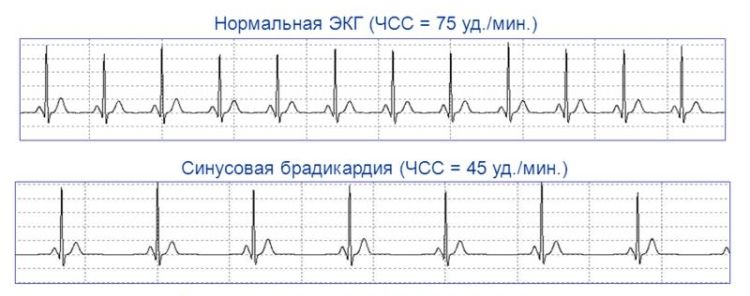 синусовая брадикардия и нормальный синусовый ритм на ЭКГ