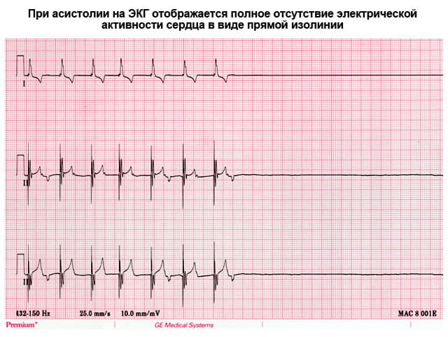 асистолия на ЭКГ