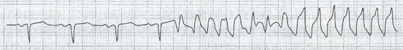 начало приступа желудочковой тахикардии на ЭКГ