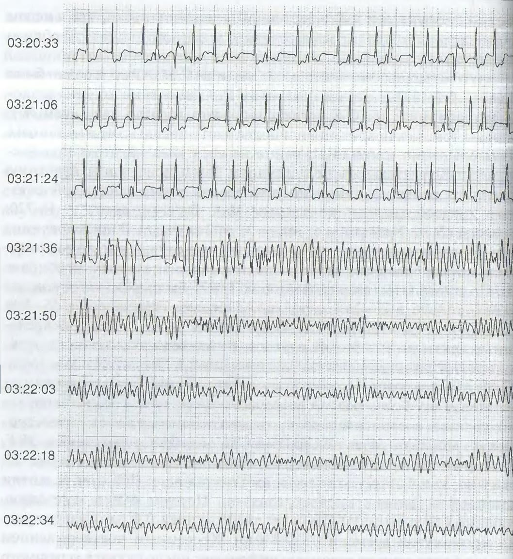 момент начала фибрилляции желудочков на ЭКГ; через 2 минуты фибрилляция желудочков становится низкоамлитудной
