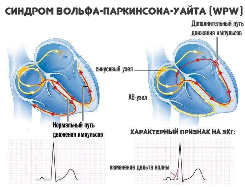 как формируется WPW синдром (синдром Вольфа-Паркинсона-Уайта)