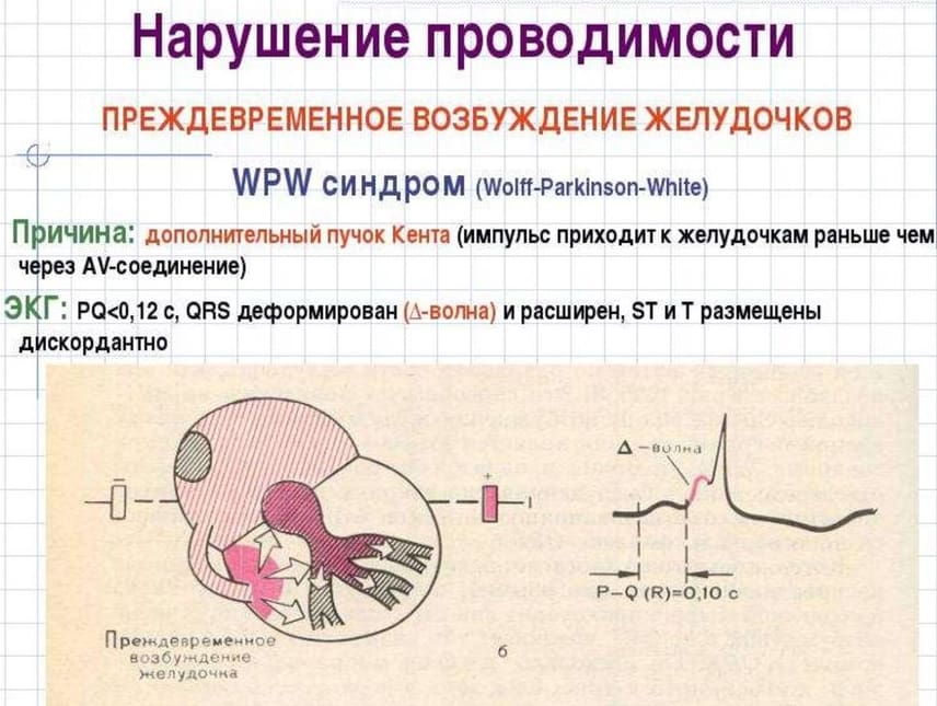 ЭКГ и формирование WPW синдрома (синдрома Вольфа-Паркинсона-Уайта)