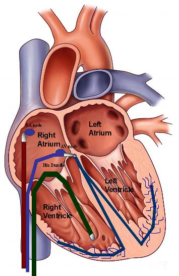электроды в полостях сердца при эндокардиальном ЭФИ