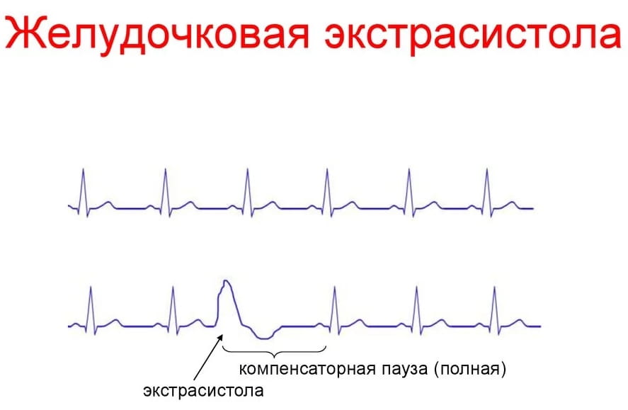 как выглядит желудочковая экстрасистола на ЭКГ