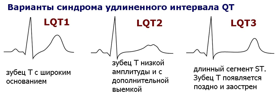 варианты синдрома удлиненного интервала QT: LQT1, LQT2, LQT3