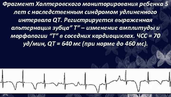 альтернация (макроальтернация) зубца T у ребенка с синдромом удлиненного интервала QT