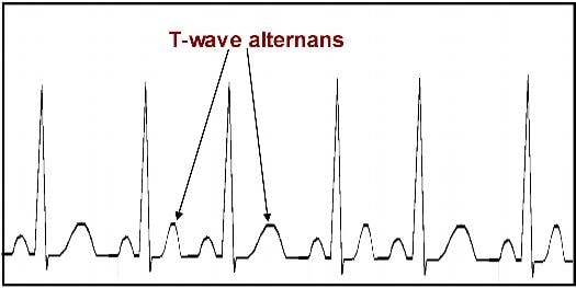 альтернация (макроальтернация) зубца T на ЭКГ